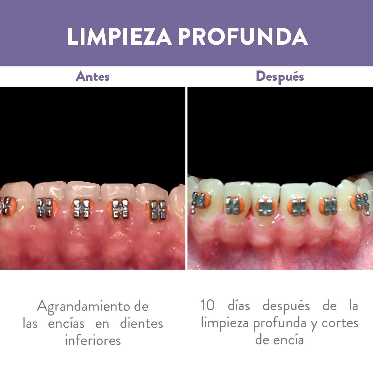 Antes y después de limpieza dental en dentadura con frenillos