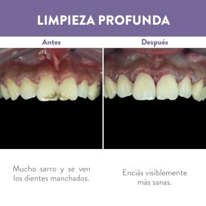 Antes y después de limpieza profunda en dientes superiores
