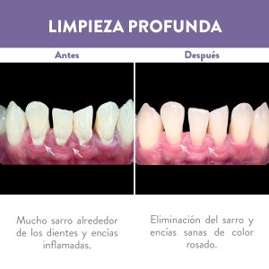 Antes y después de limpieza profunda en dentadura inferior