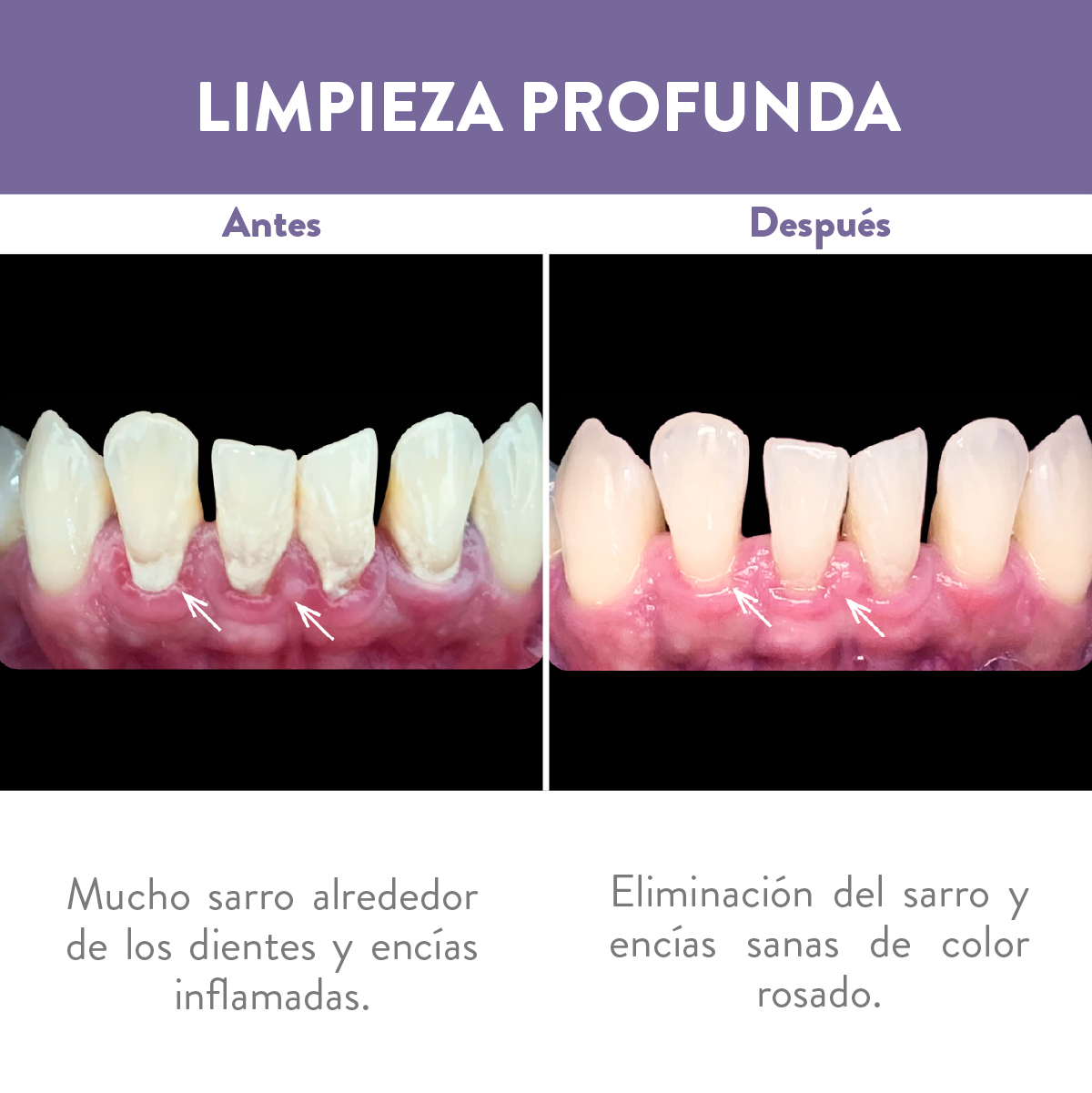 Antes y después de limpieza profunda en dentadura inferior