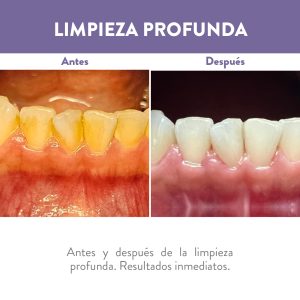 Antes y después de limpieza dental profunda