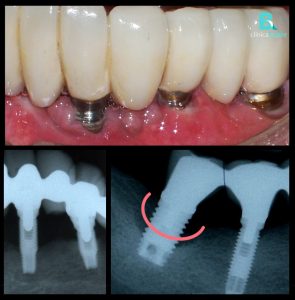 perdida de hueso en los implantes dentales